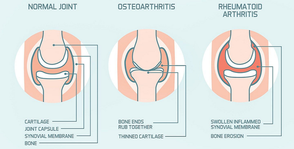 DON’T LET ARTHRITIS RUIN YOUR LIFE !  Osteoarthritis is Painful (ROOT CHAKRA)