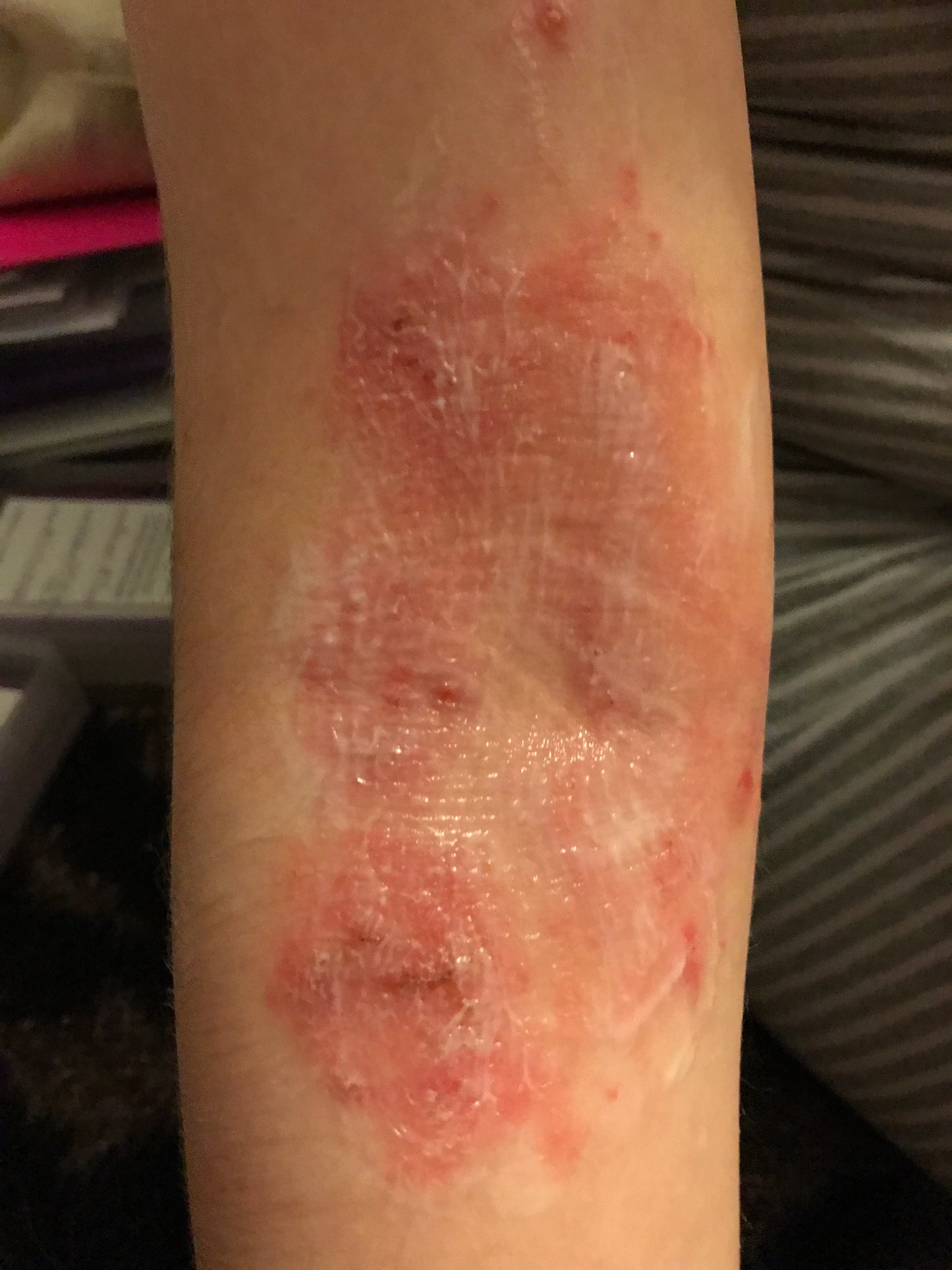Eczema Treatment - Instant Results - Derma Soothe Skin Lotion+ 100ml - Vitali-Chi - Pure and Natural