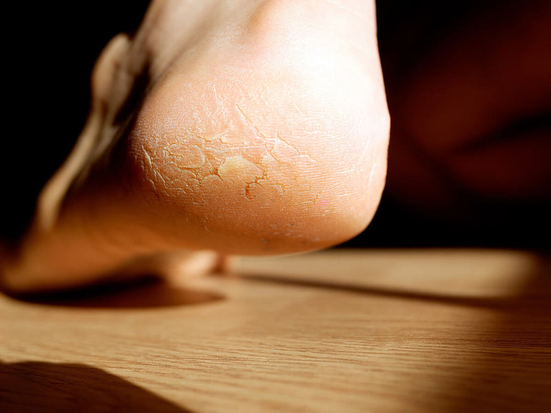 Eczema & Dry & Cracked Heels Treatment  - Hand & Foot Cream+ by VGeneré - Cracked Heel Balm